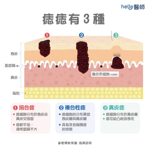 臉上長誌|痣形成的原因？痣長毛、痣變多變大是痣病變？5招判。